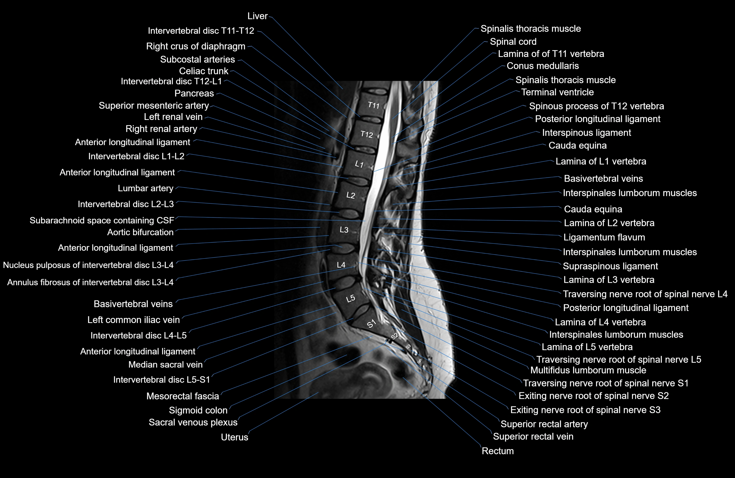 MRI lumbar spine sagittal cross sectional anatomy 3T radiology  image-img-00001-00015.webp